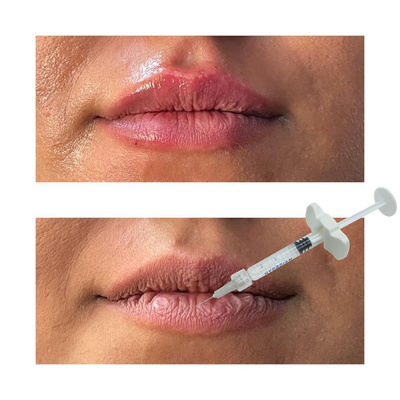 Meningkatkan bibir Anda dengan RED paten Lip Filler Aman Dan Efektif Lip Augmentation