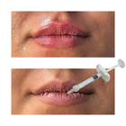 Injeksi Hyaluronic Acid Filler Dermal Filler Lip Enhancement Fillers