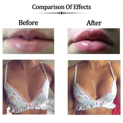 Cross Linked Hyaluronic Acid Filler Crosslinked Gel - Sodium Hyaluronate yang telah terbukti secara klinis