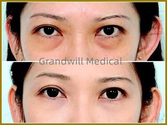 Pengisi Kulit Wajah Asam Hyaluronic Untuk Mengisi Tear Trough Eye Circle