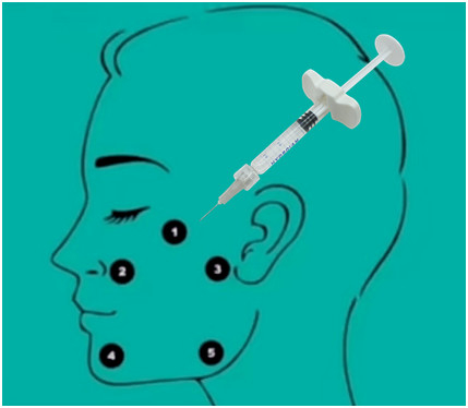 32mg H-HA L-HA Non Cross Linked Hyaluronic Acid Filler Gel Asam Hyaluronic