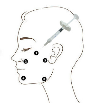 OEM Profhilo H+L 32mg Non Cross Linked Hyaluronic Acid Filler Injeksi 5 Poin