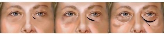 1ml 2ml Larutan Asam Hyaluronic Injeksi Menghilangkan Lingkaran Hitam Mata