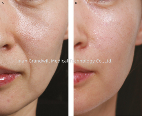 PCL Advanced Filler Injeksi dengan Polycaprolactone Hyaluronic Acid untuk Penghapusan Kerutan