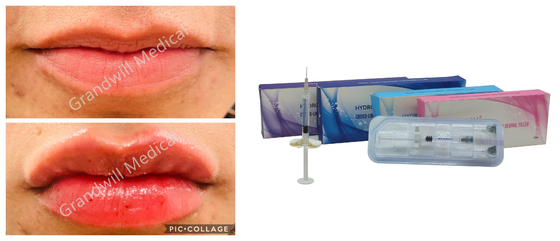 Asam Hyaluronic Lip Filler Kerutan Payudara Kegel Pembesaran untuk Hasil yang Lama