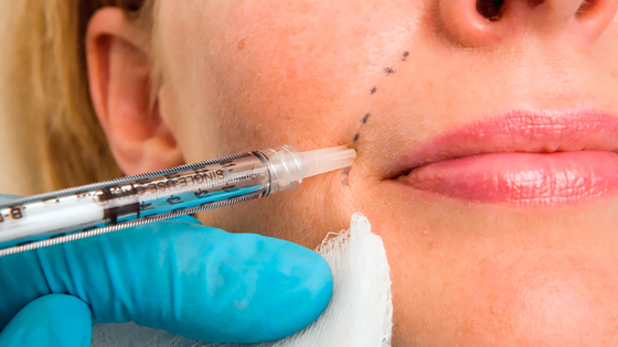 50ml Asam Hyaluronic Injeksi Filler Dermal Facial Chin Dengan Lidocaine PCL Plla Filler Injeksi