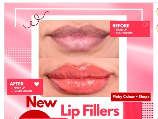 Fungsi Bibir Dermal Lip Fillers 1ml Untuk OEM Natural Looking Plumping Lip Fillers