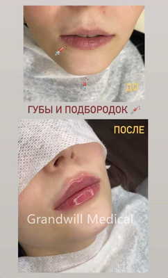 24mg/ml Injeksi Hyaluronic Acid Filler Dermal untuk Smoothing Kerutan