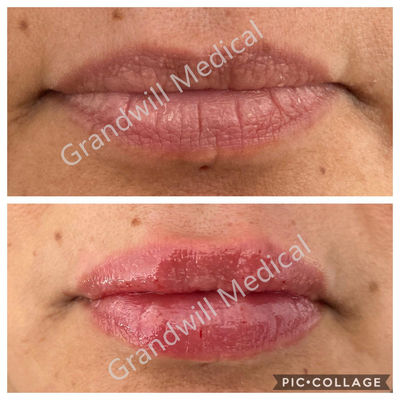 Injeksi Asam Hyaluronic Lip Filler yang terlihat alami Non- Bedah Lip Enhancement