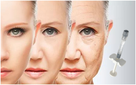 Pengisi Wajah Asam Hyaluronic 24mg / Ml Untuk Depresi Pipi Kaki Gagak