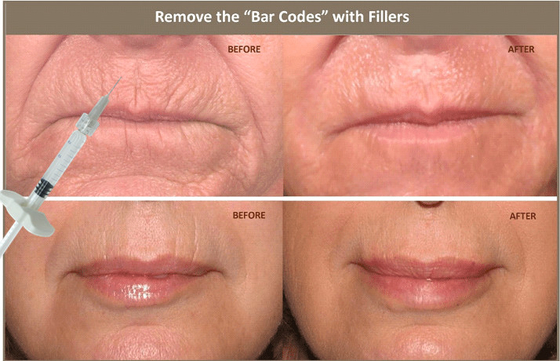 10ml Suntik Hyaluronic Acid Dermal Filler Untuk Memperbaiki Asimetri Wajah