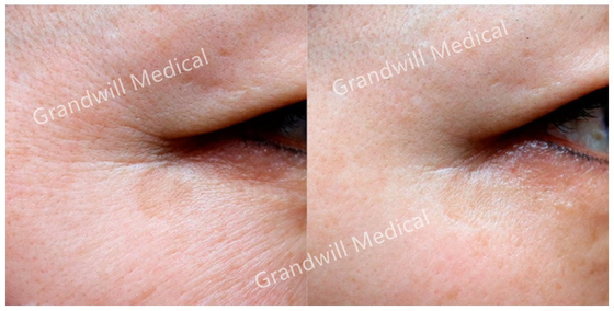 Polycaprolactone Hyaluronic Acid Serum Kolagen Peremajaan Pengisi Injeksi PCL