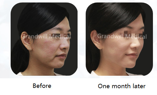 CMC PCL Dermal Filler Collagen Stimulator Untuk Menghilangkan Keriput Wajah