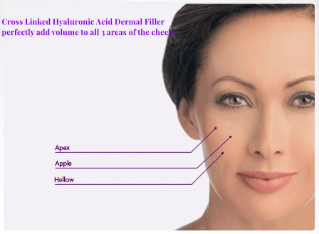Injectable Sodium Hyaluronate Dermal Filler Midface Volume Loss Treatment Pipi Gemuk