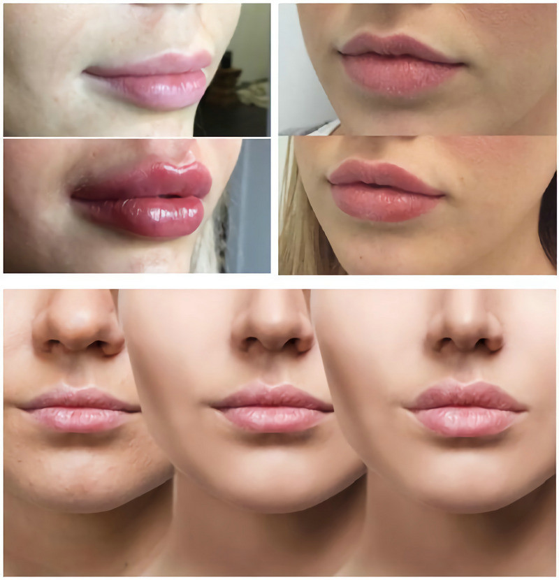 Garis Halus / Bibir Gemuk Dengan Pengisi Injeksi Asam Hyaluronic 1ml 2ml 5ml
