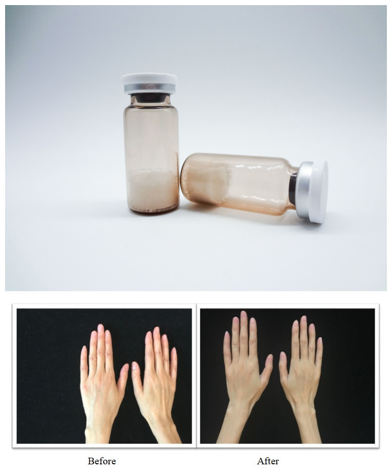 Filler Kulit Wajah Steril PLLA Asam Hyaluronik Gel Injeksi Dirancang untuk Koreksi Kerutan Lurus dan Pemulihan Volume Wajah