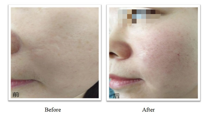 350mg 150mg PLLA Filler Dermal OEM Disesuaikan Injeksi Plla Untuk Hasil yang Lama