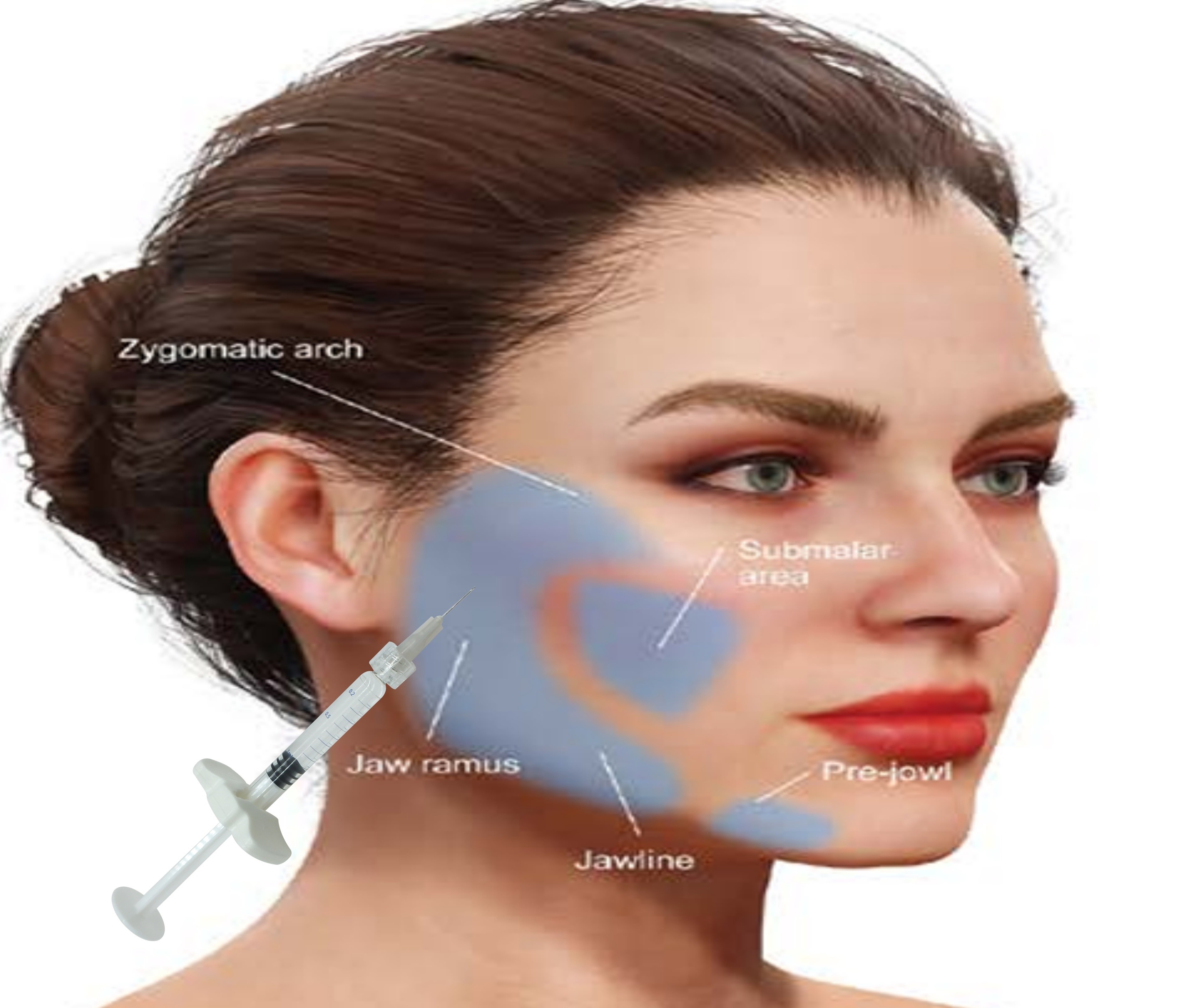 Hyaluronic Acid HA Kalsium Hydroxyapatite Filler Dapatkan Wajah yang terlihat alami dengan 1ml Syringe