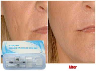 Pengisi Suntik Asam Hyaluronic 10ml Untuk Augmentasi Pipi Injeksi Bibir