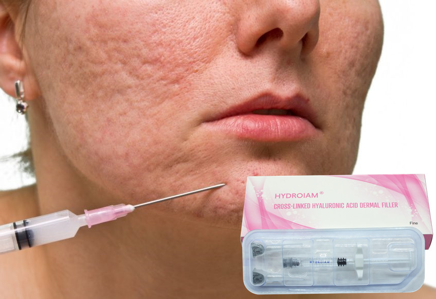 1ml Sodium Hyaluronate Gel Injeksi Untuk Menghilangkan Keriput Wajah Halus