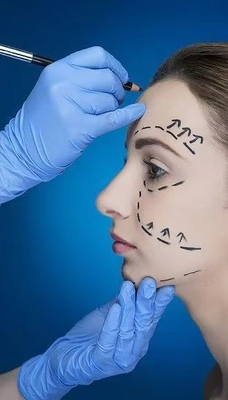 Lemparan halus dan Jawline yang jelas Dengan Pengisi Kulit Wajah 70% HA Cross Linked 24mg 30% Kalsium Hydroxylapatite