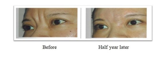 350 mg 150 mg PLLA Poly L Lactic Acid Filler untuk Pengobatan Kerutan Wajah