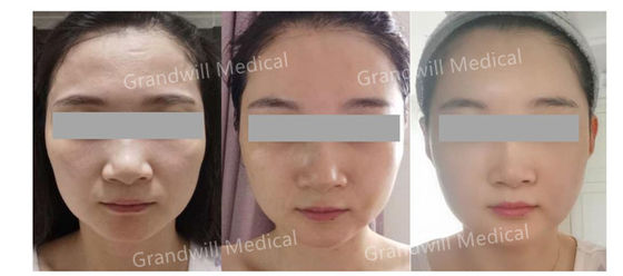 Pengisi Dermal Asam Hyaluronic Cross Linked Steril yang Dirancang untuk Kontur Wajah Tampak Alami dan Peremajaan Kulit